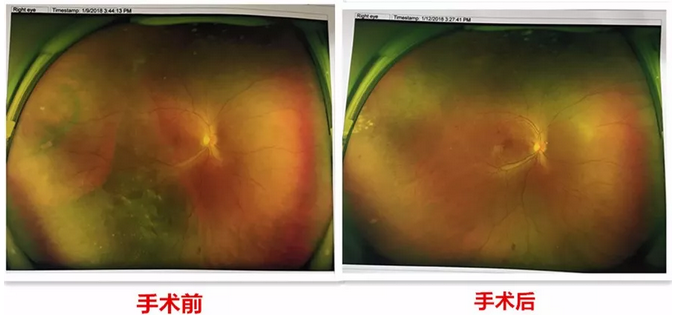 去年小李怀孕时，视力明显下降，甚至影响到了正常生活，这时已从怀孕初期的喜悦中冷静下来的小李，找到了福州眼科医院进行了一*次眼部检查。2.png