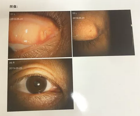 成都6686在线登录官网入口-6686(中国)罗清礼院长为四处求医未果的河南眼眶肿瘤患者手术2.png