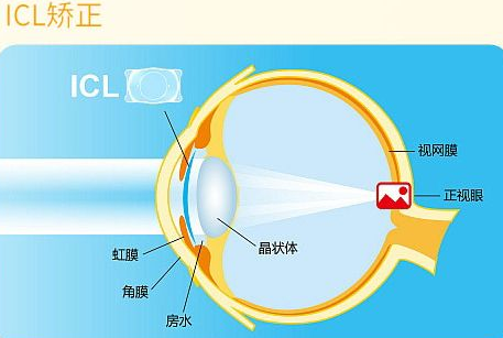 近视无法根治？但你可以这样做？6686在线登录官网入口-6686(中国)“有爱就有希望”近视手术火热进行中8.png